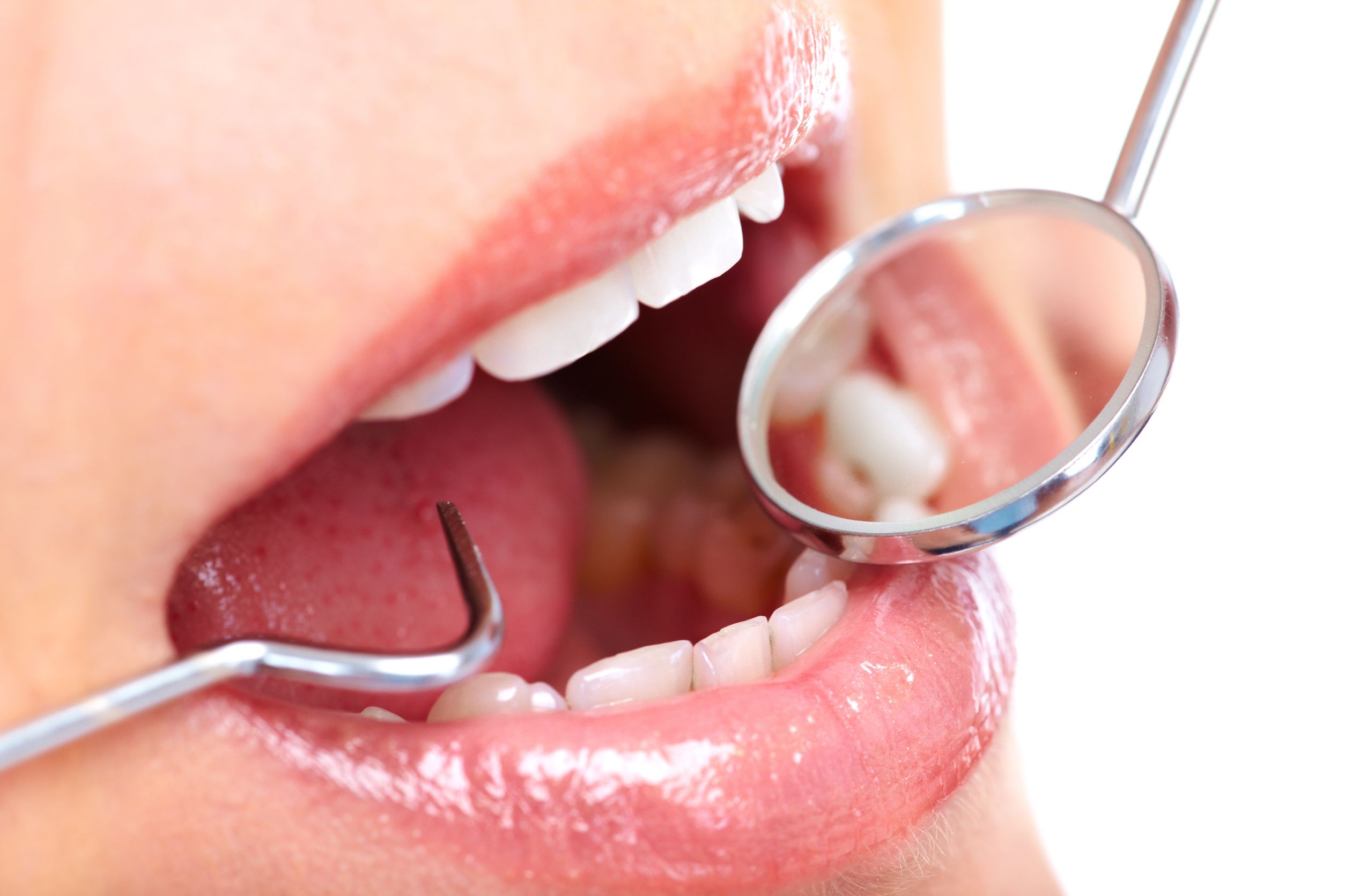 Dental Bridges North Oklahoma City OK