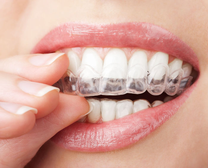 Professional Invisalign In St. Augustine