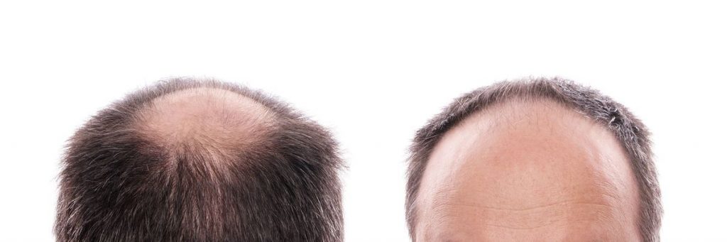 Scalp Micropigmentation Seattle