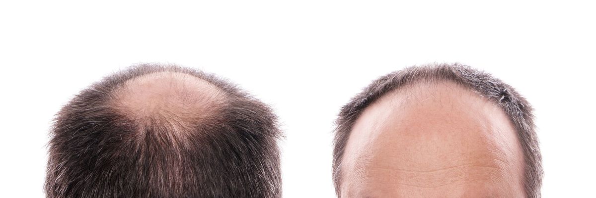 Scalp Micropigmentation Seattle