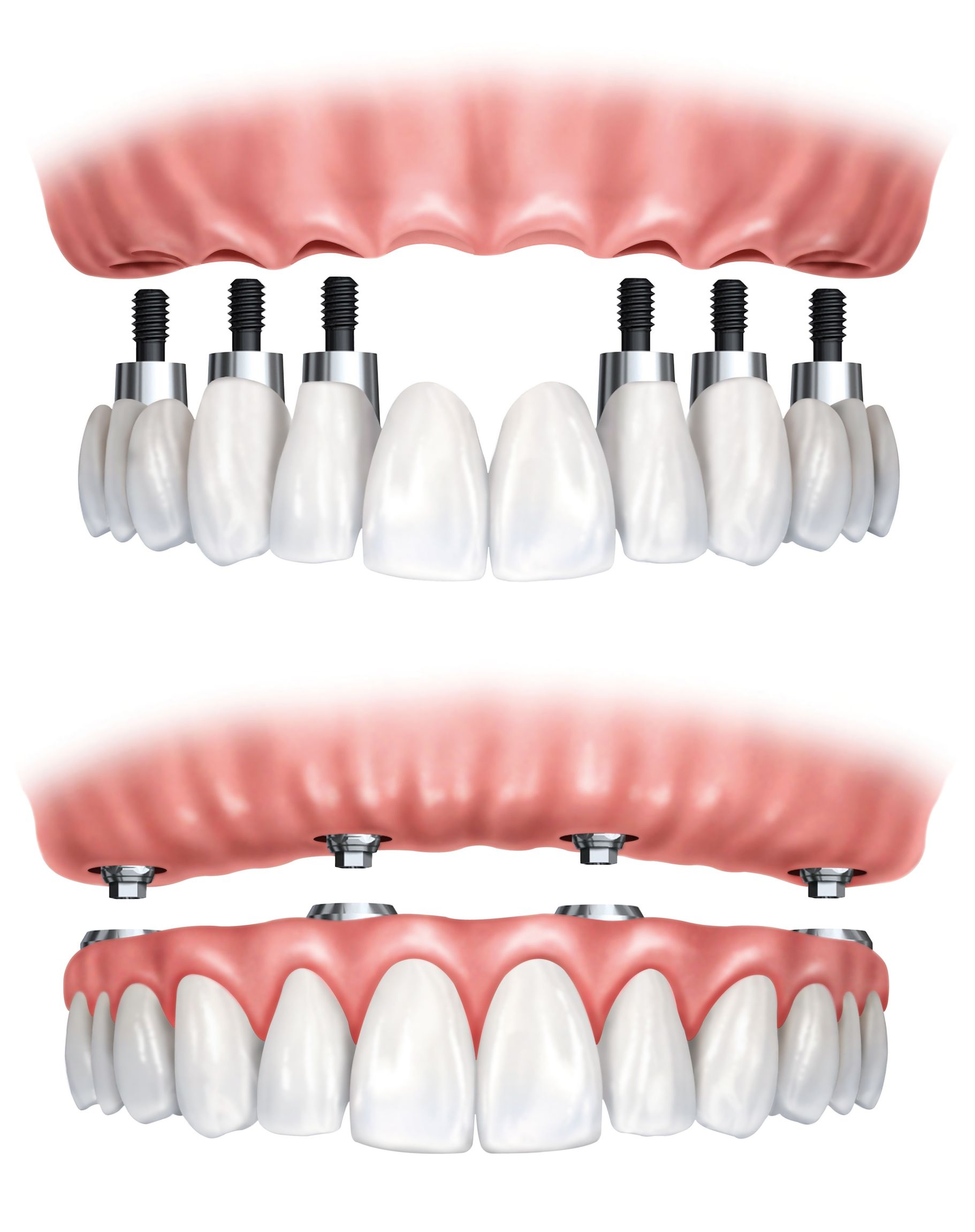 Smile Exchange of Hatfield Provides The Finest Root Canal Therapy In Hatfield