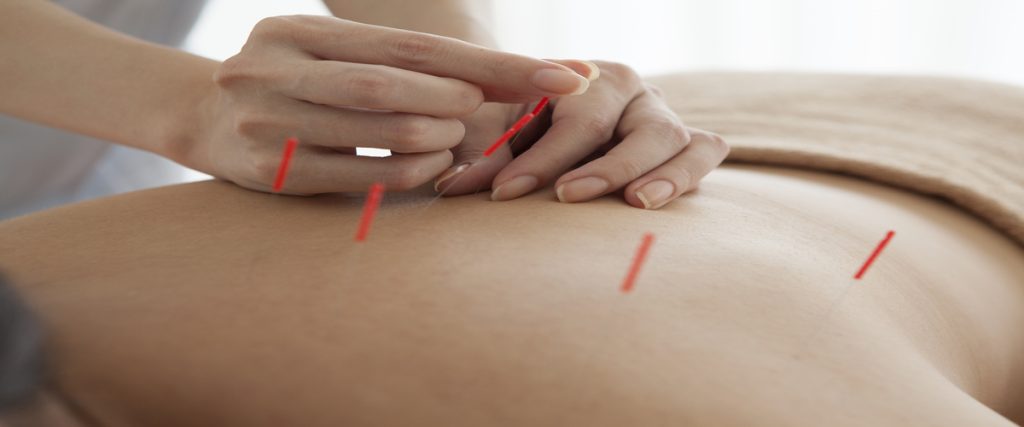 Acupuncture For Pain In Bellingham WA